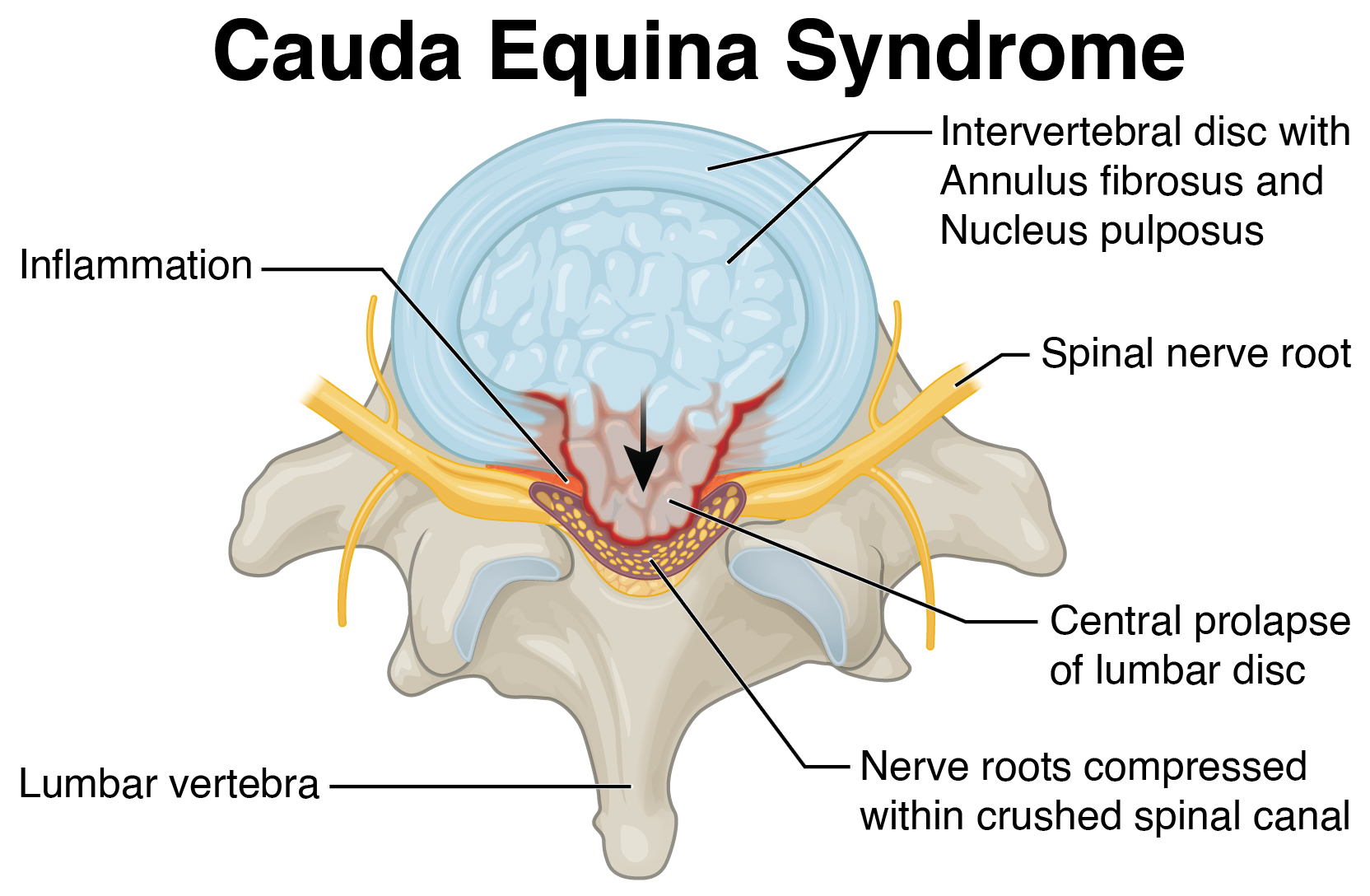 Cauda Equina Syndrome C Jones And Associates Llc 5056